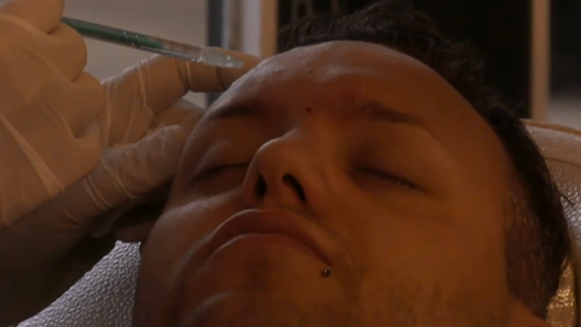 Video: botox behandeling van Michael